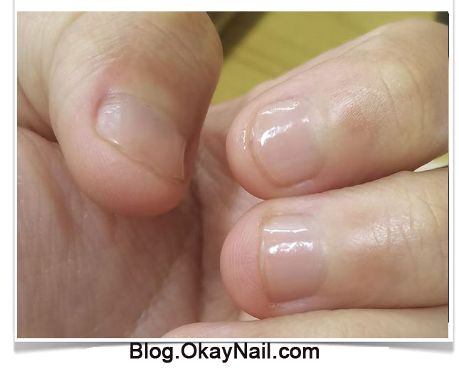 short nail need nail care